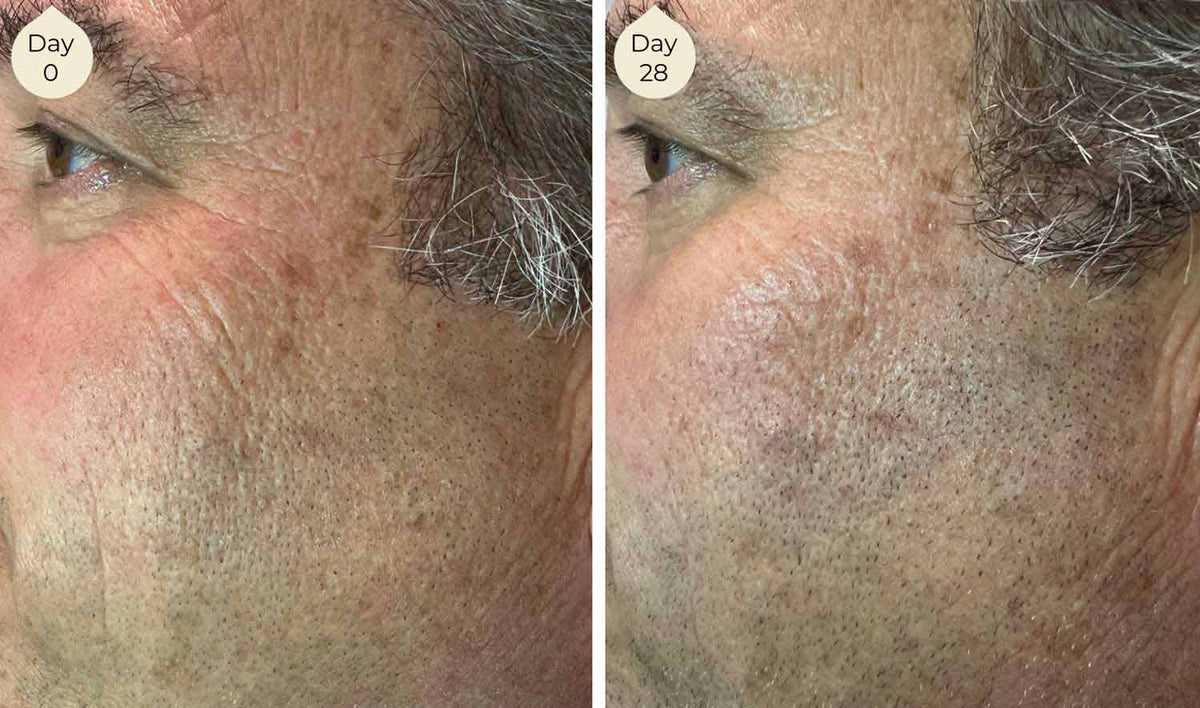 LightWater Skin Nutrition facial skincare before and after showing reduced wrinkles, more even skin tone, and overall improved appearance