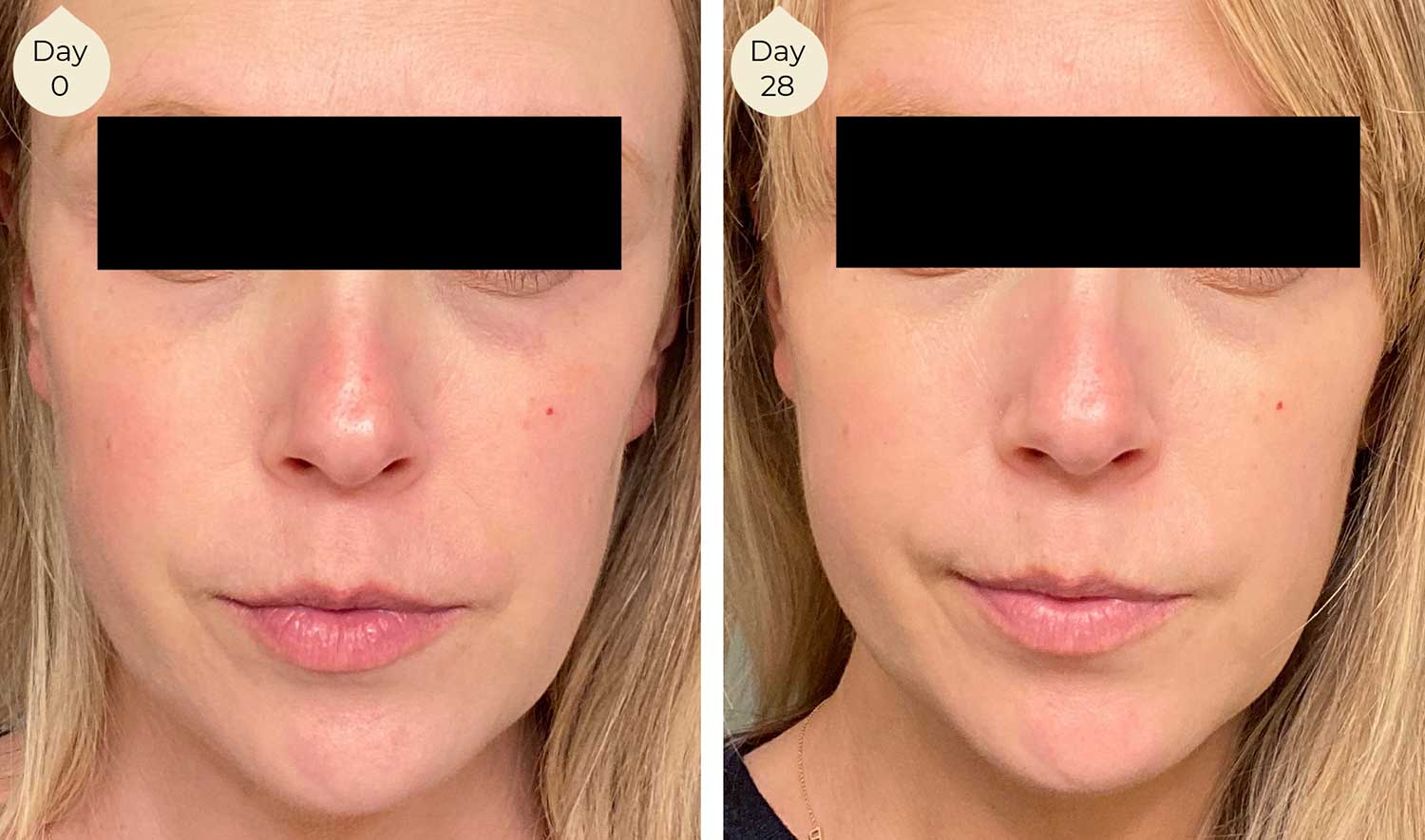 LightWater Skin Nutrition facial skincare before and after shows more even skin tone, less redness, reduced under eye circles, better overall appearance