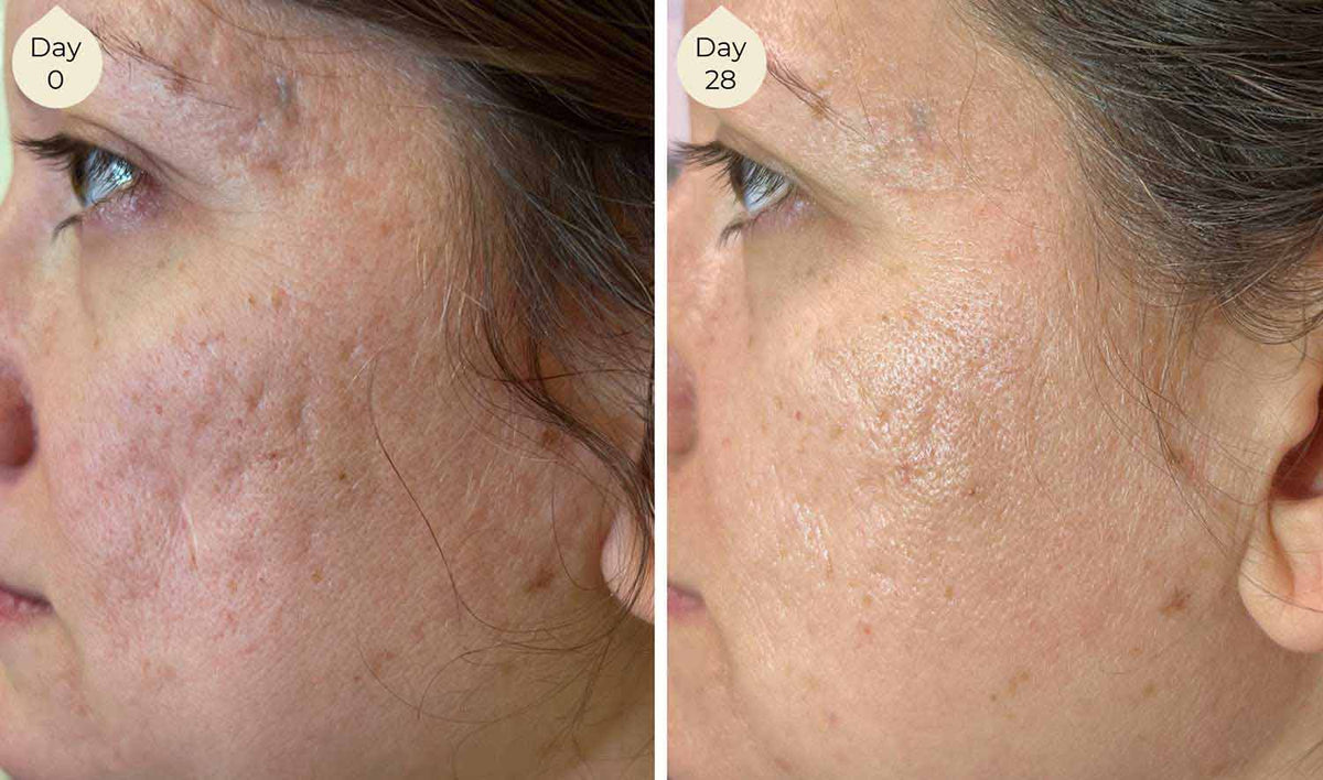 LightWater Skin Nutrition facial skincare before and after shows reduced redness, less visible acne scarring, more even skin tone, youthful glow, and overall improved appearance